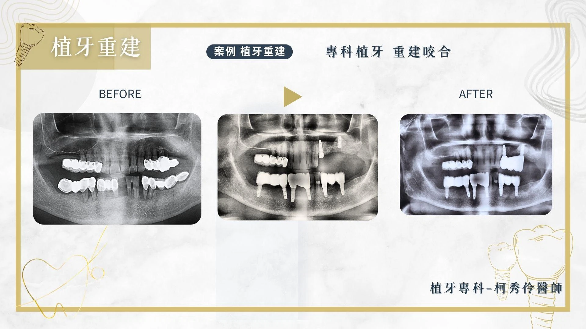 人工植牙案例 人工植牙案例
