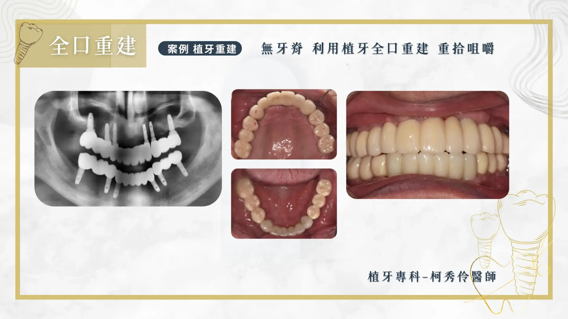 人工植牙案例 全口重建