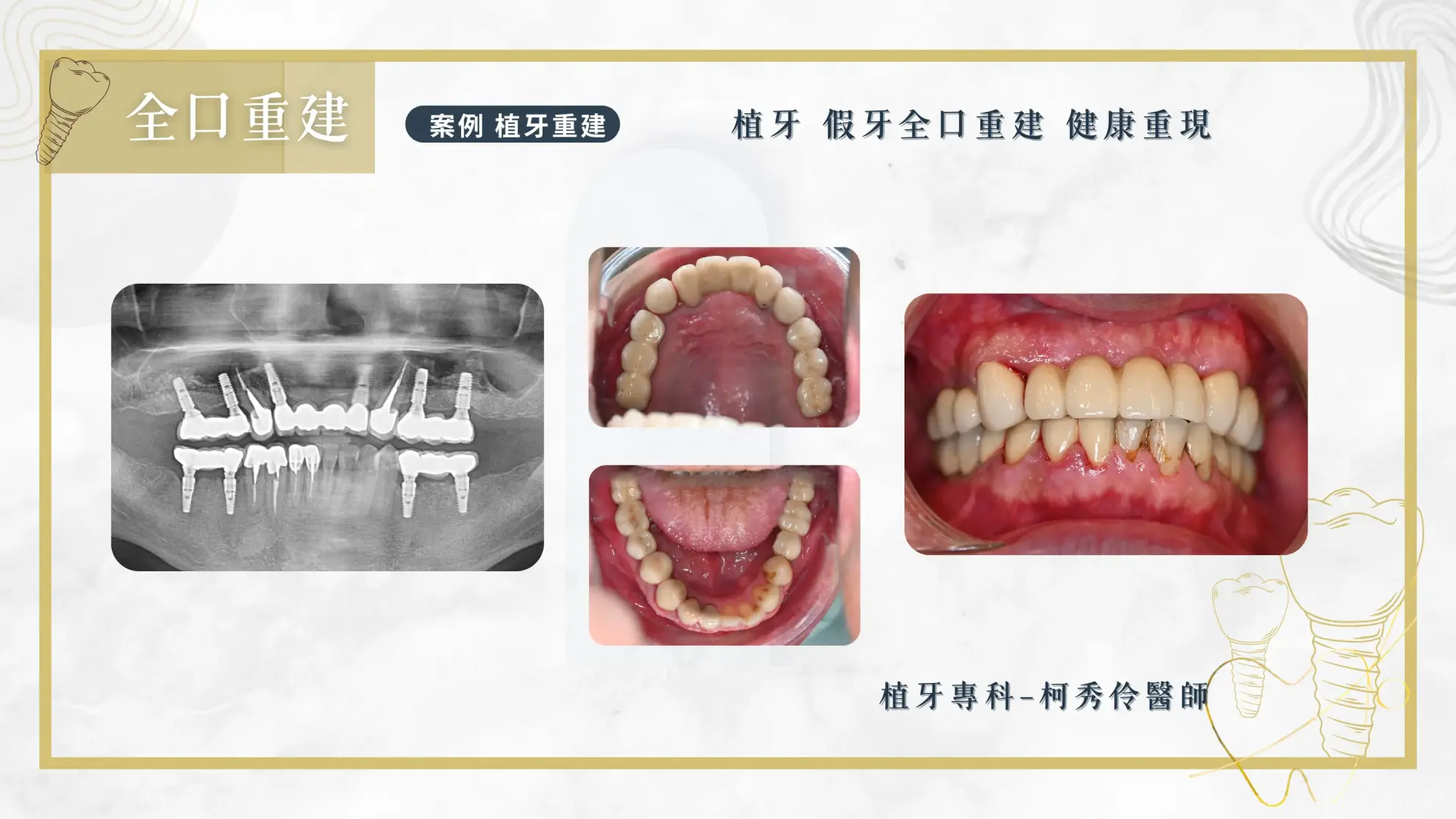 人工植牙案例 全口重建