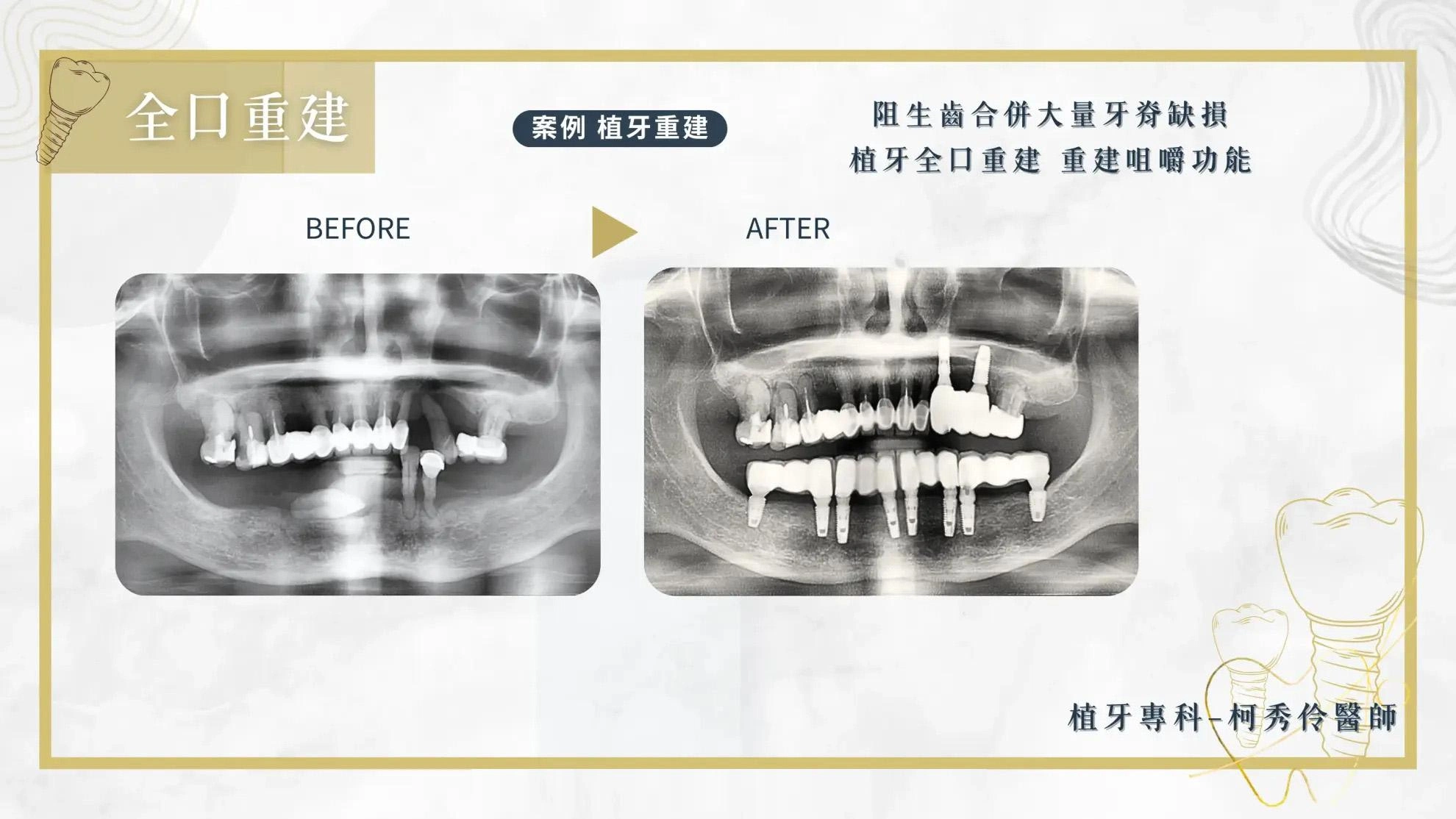 人工植牙案例 全口重建