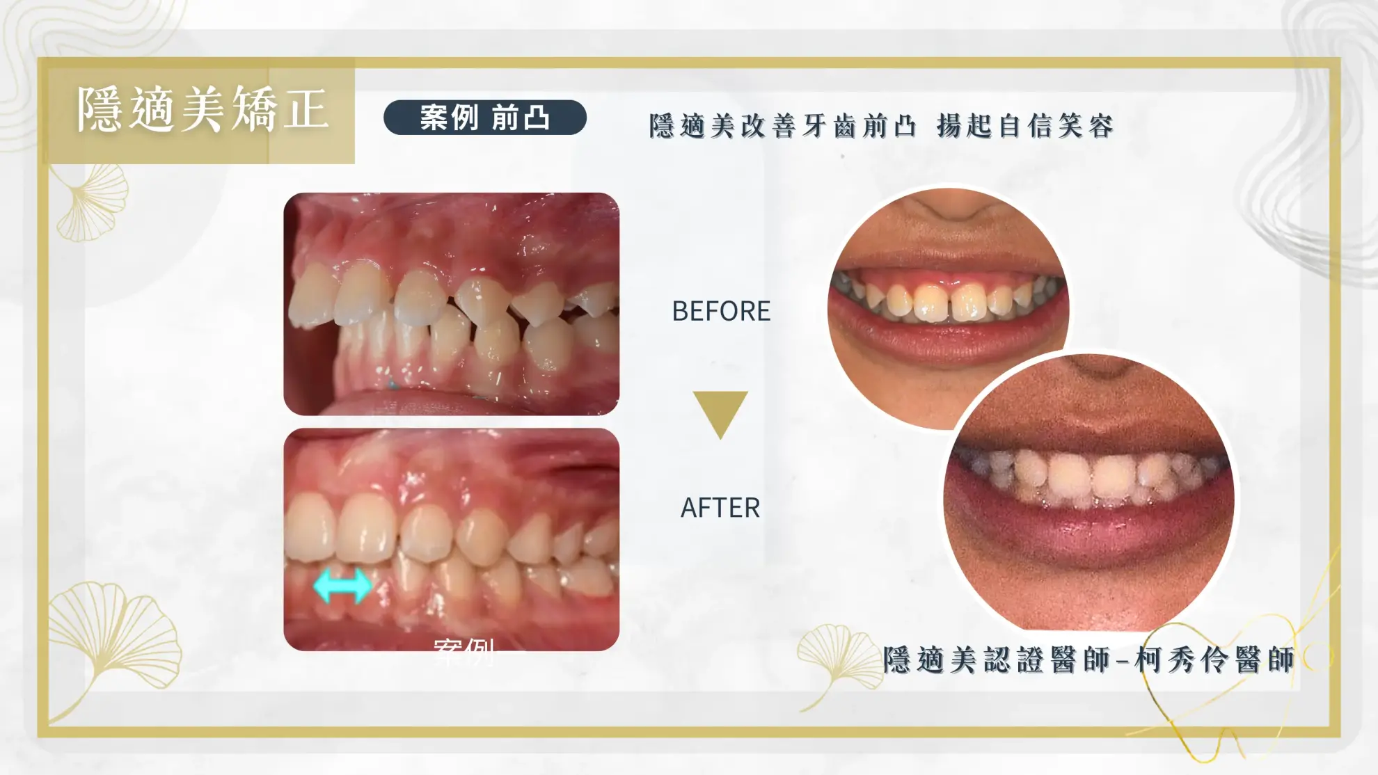隱形矯正案例 隱形矯正案例