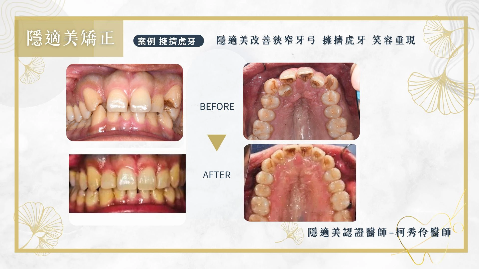 隱形矯正案例 隱形矯正案例
