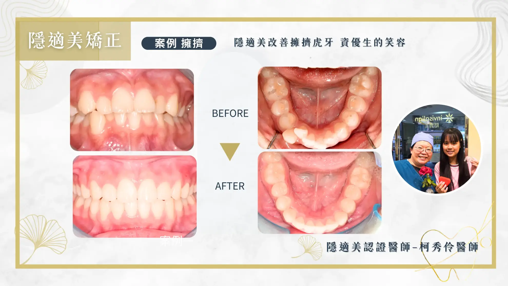 隱形矯正案例 隱形矯正案例