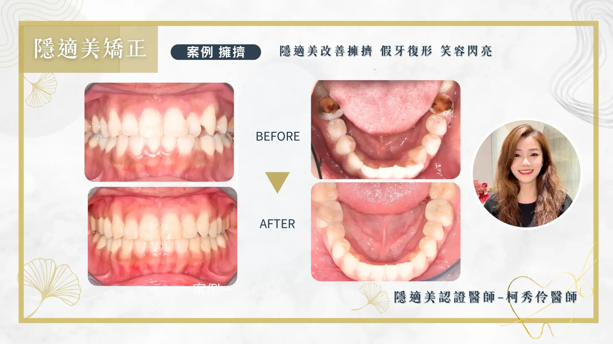 隱形矯正案例 隱形矯正案例