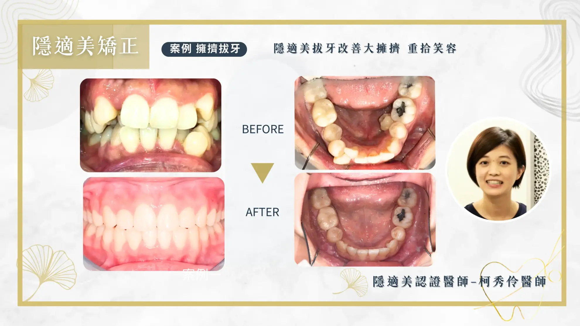 隱形矯正案例 隱形矯正案例