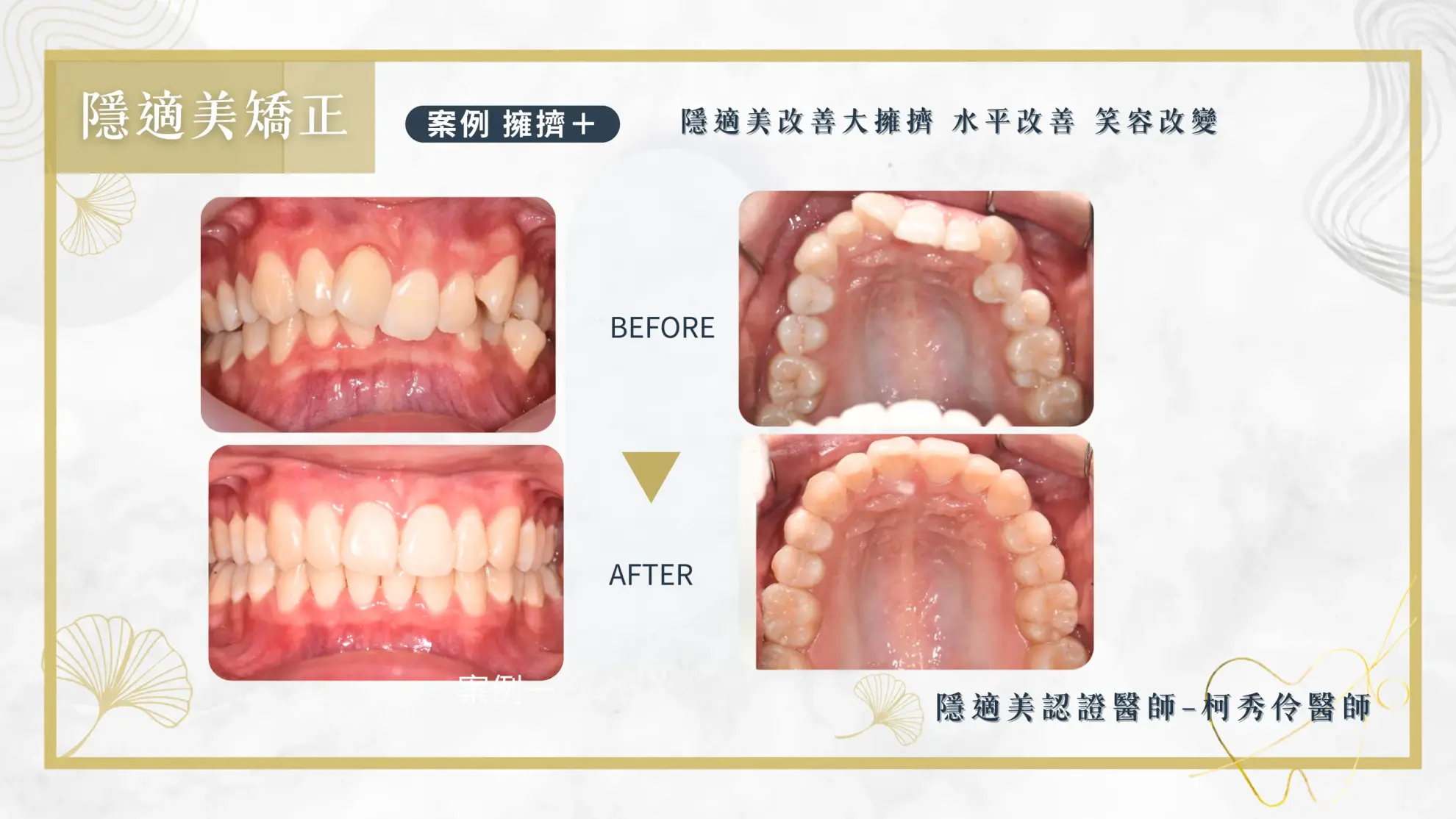 隱形矯正案例 隱形矯正案例