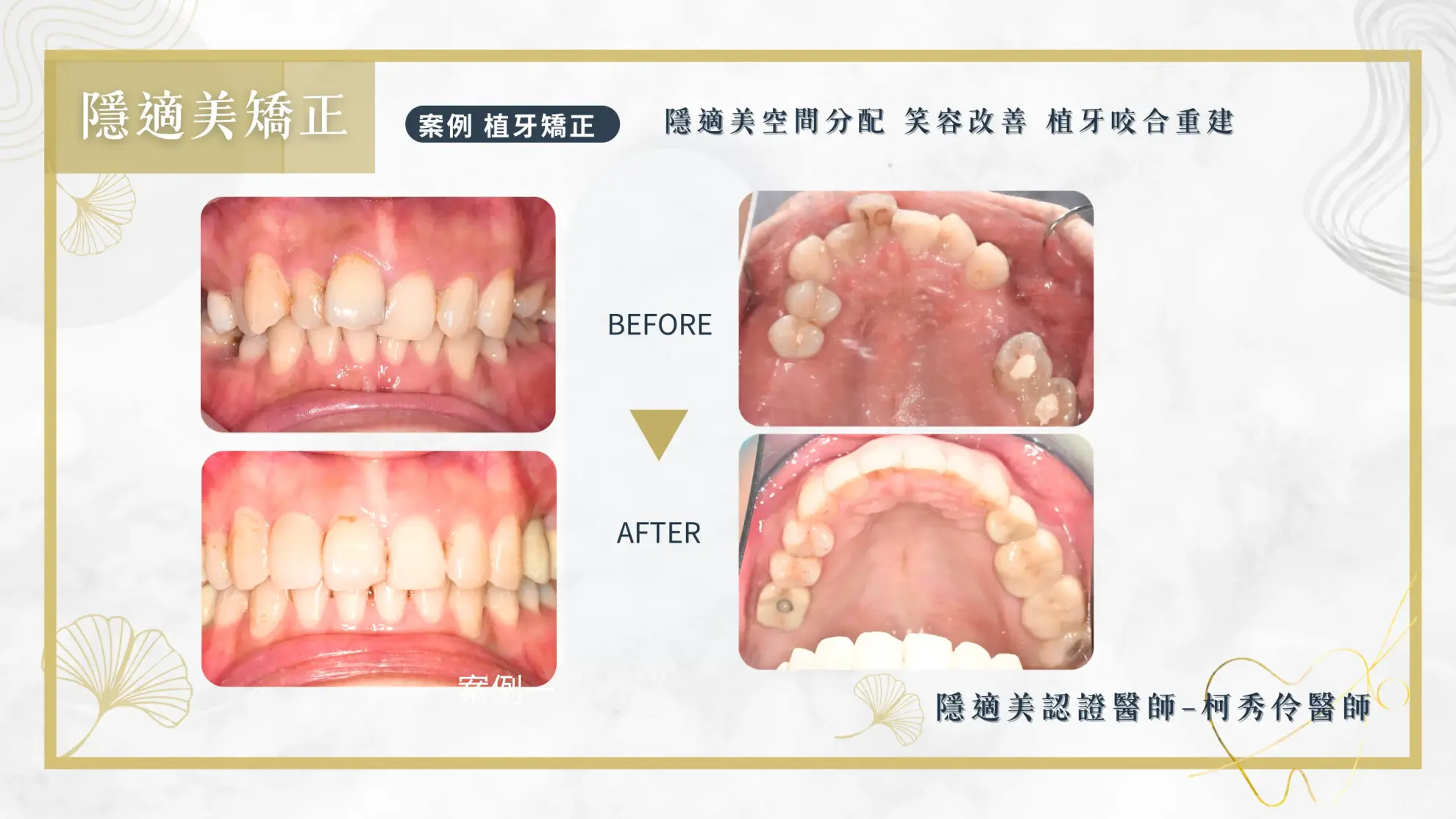 隱形矯正案例 隱形矯正案例