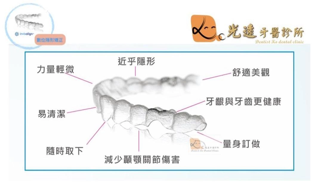 隱適美隱形矯正