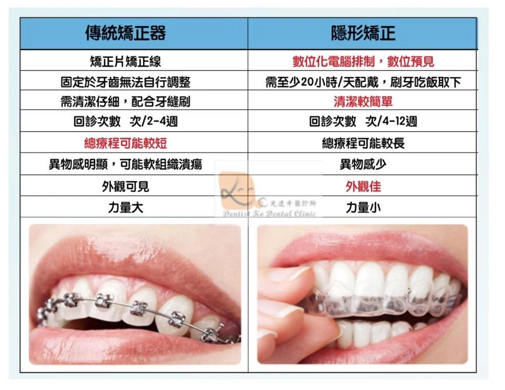 隱適美隱形矯正