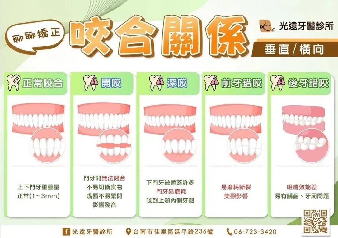 隱適美隱形矯正