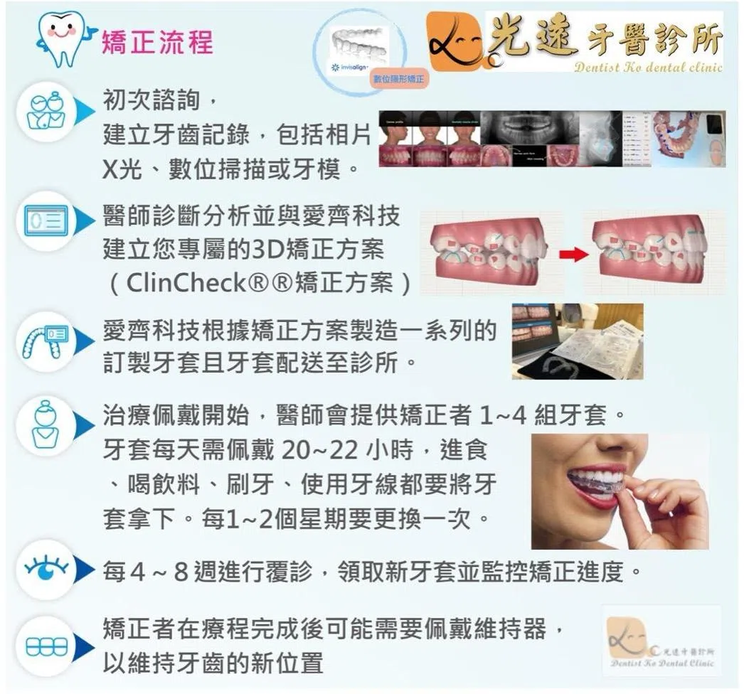 隱適美隱形矯正