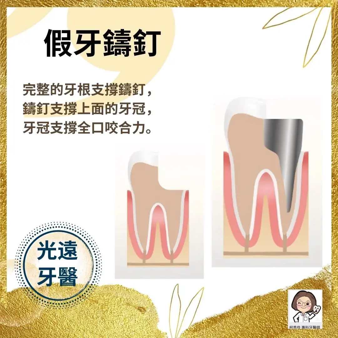 精密假牙 假牙需求