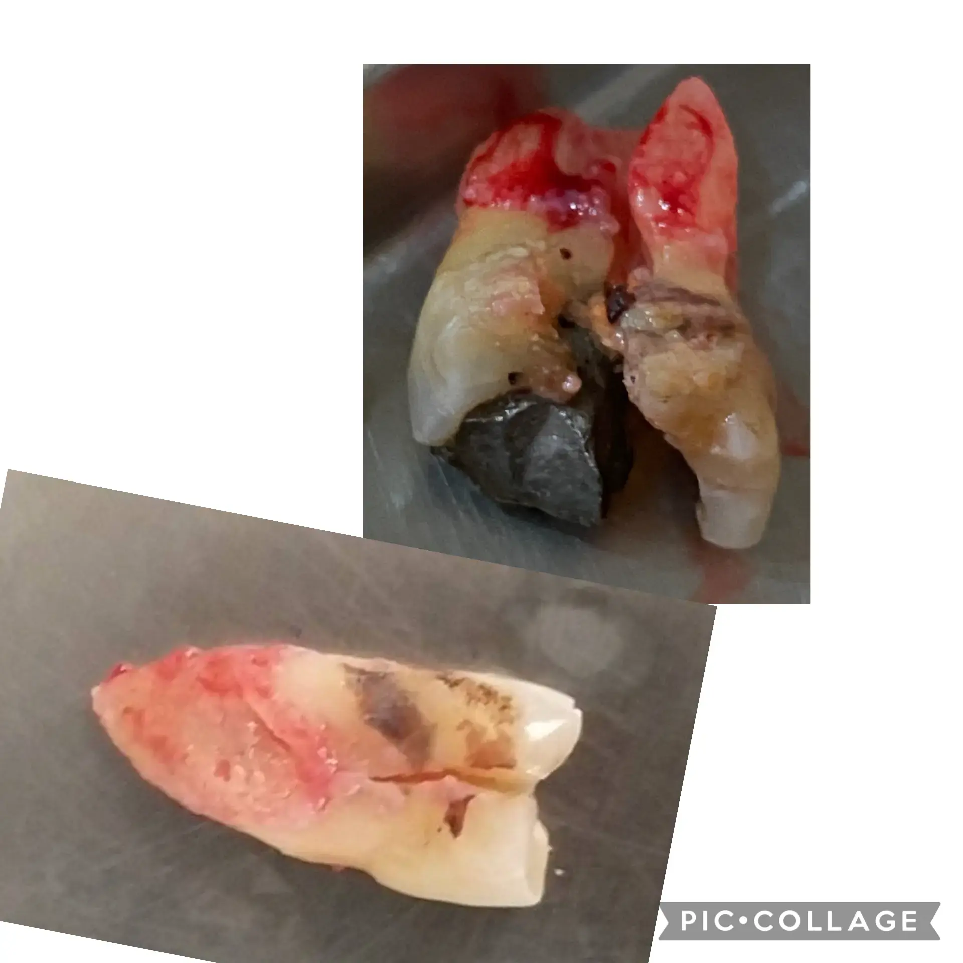 精密假牙 假牙需求