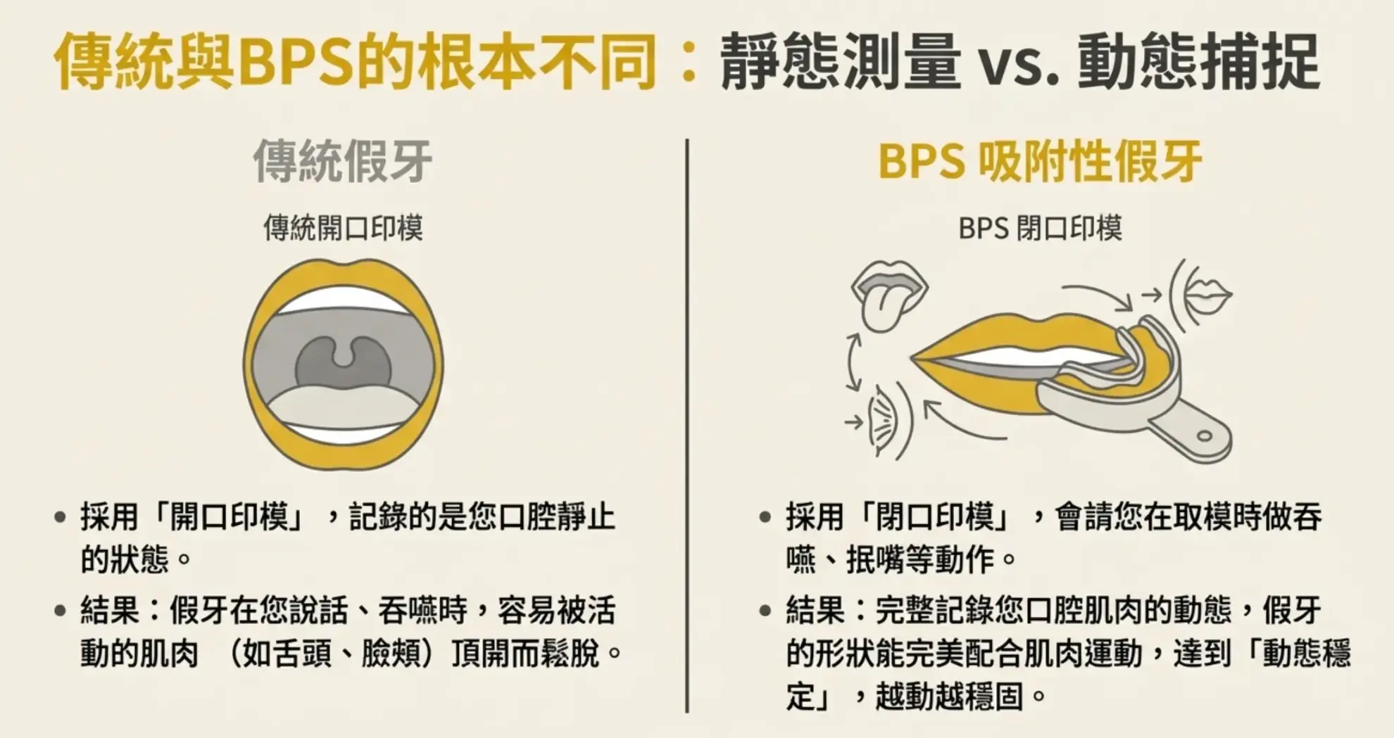 吸附式全口活動假牙