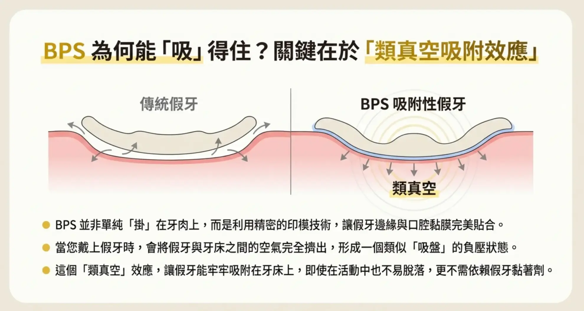 吸附式全口活動假牙