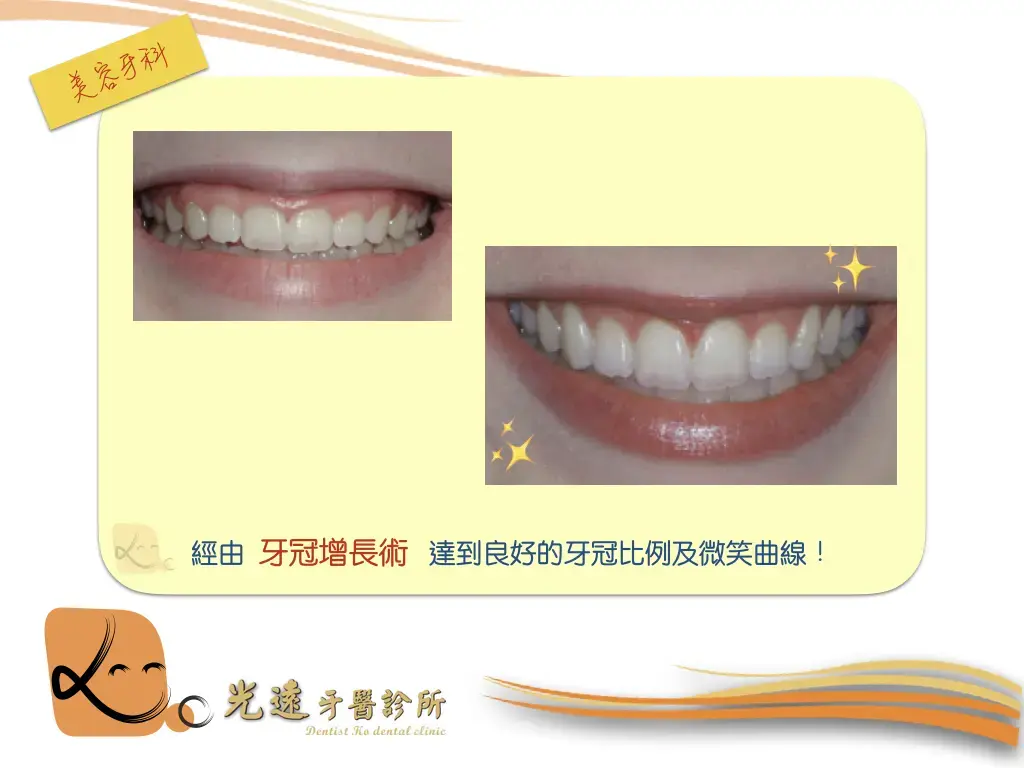 牙齒美白