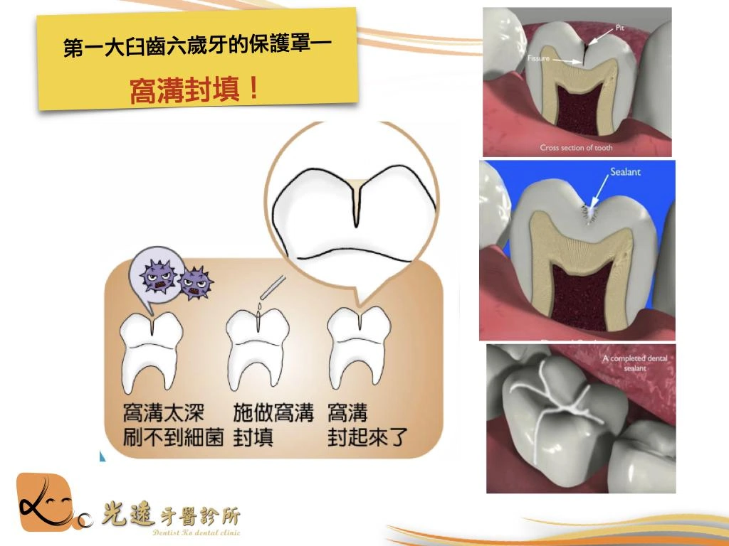窩溝封填
