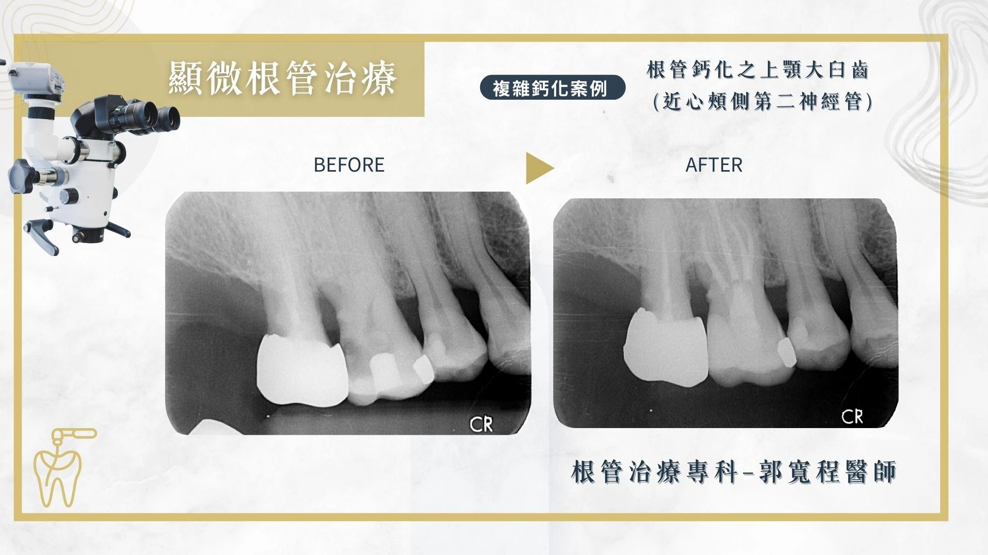 顯微根管治療