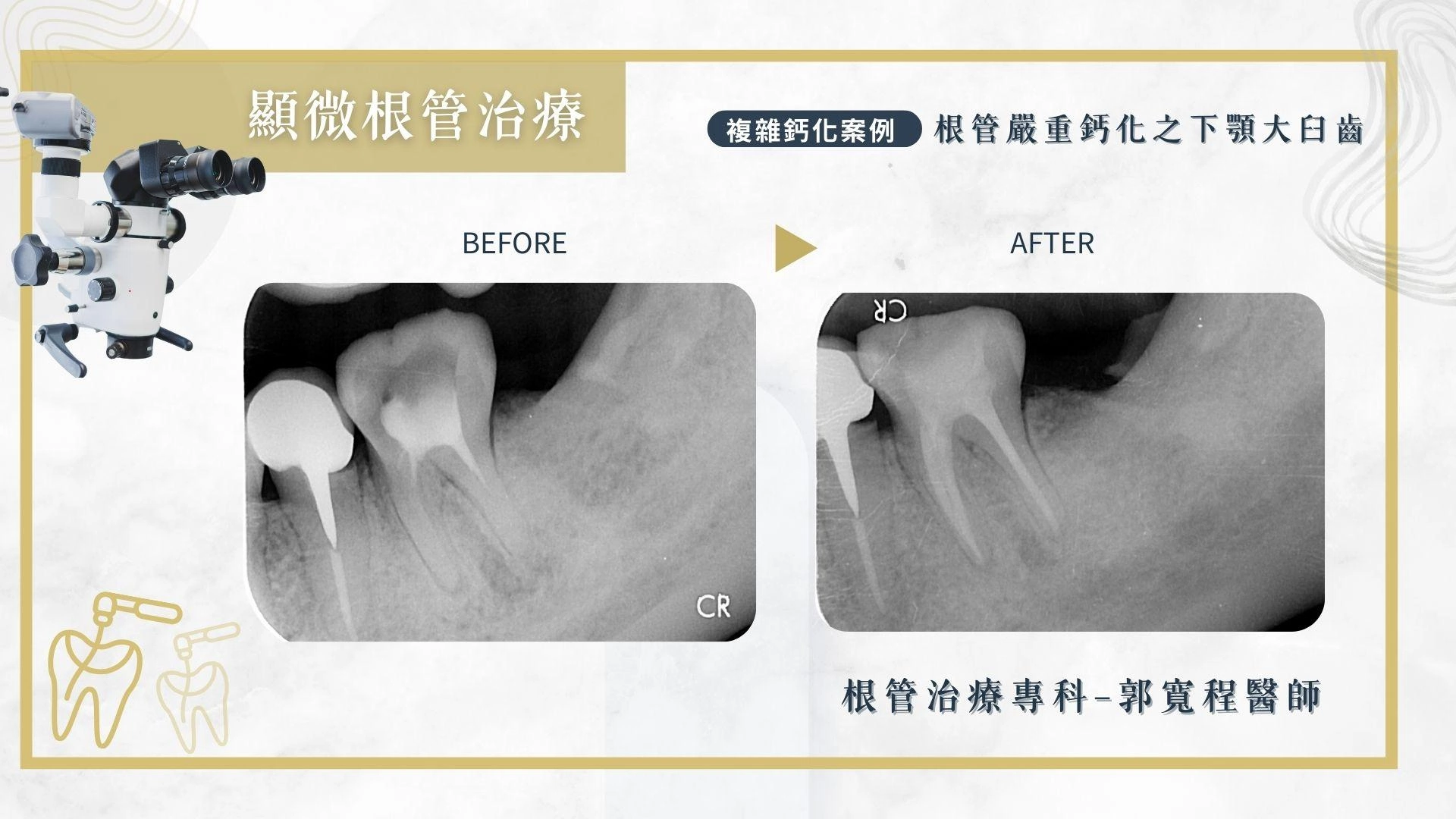 顯微根管治療
