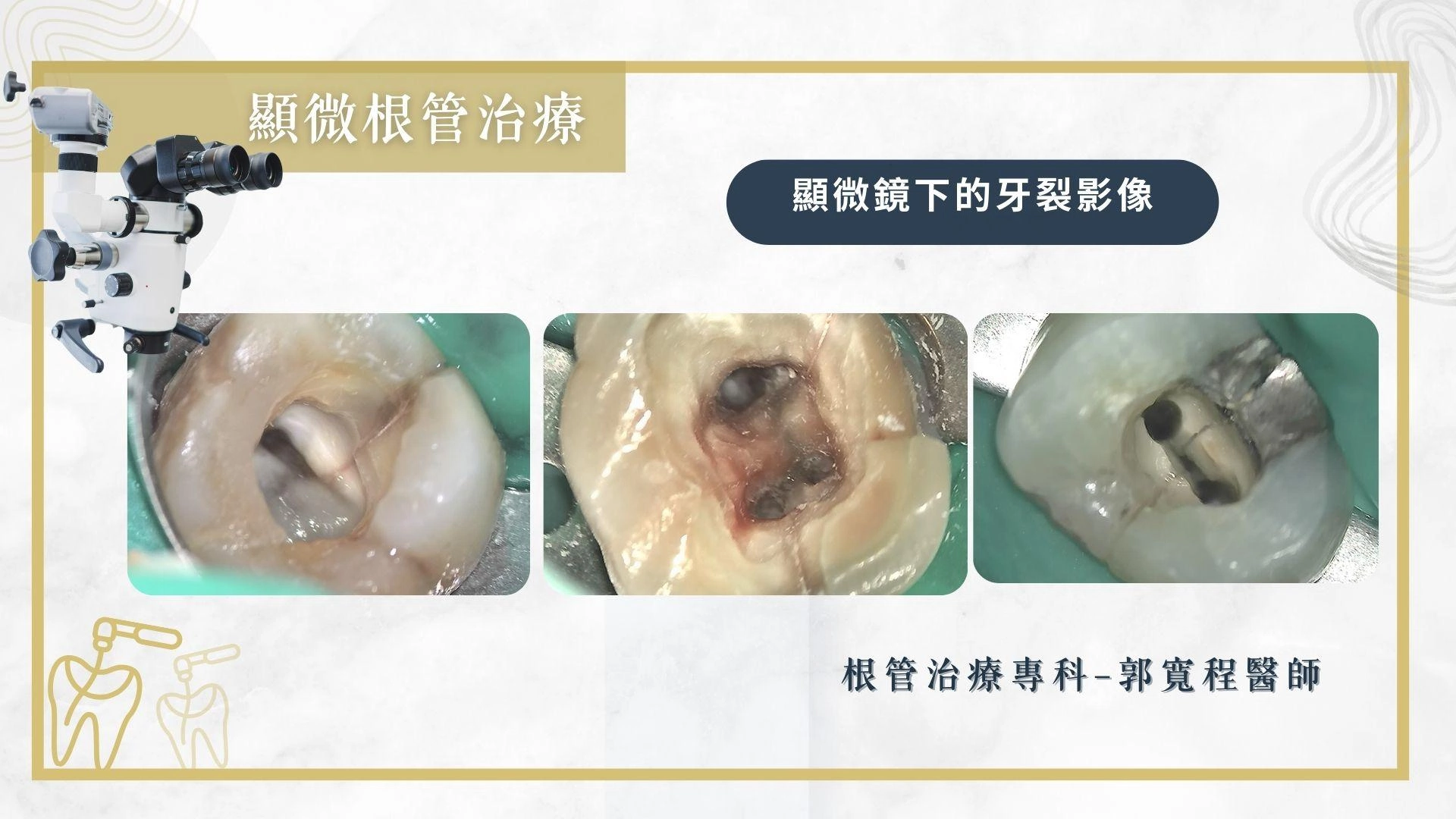 顯微根管治療