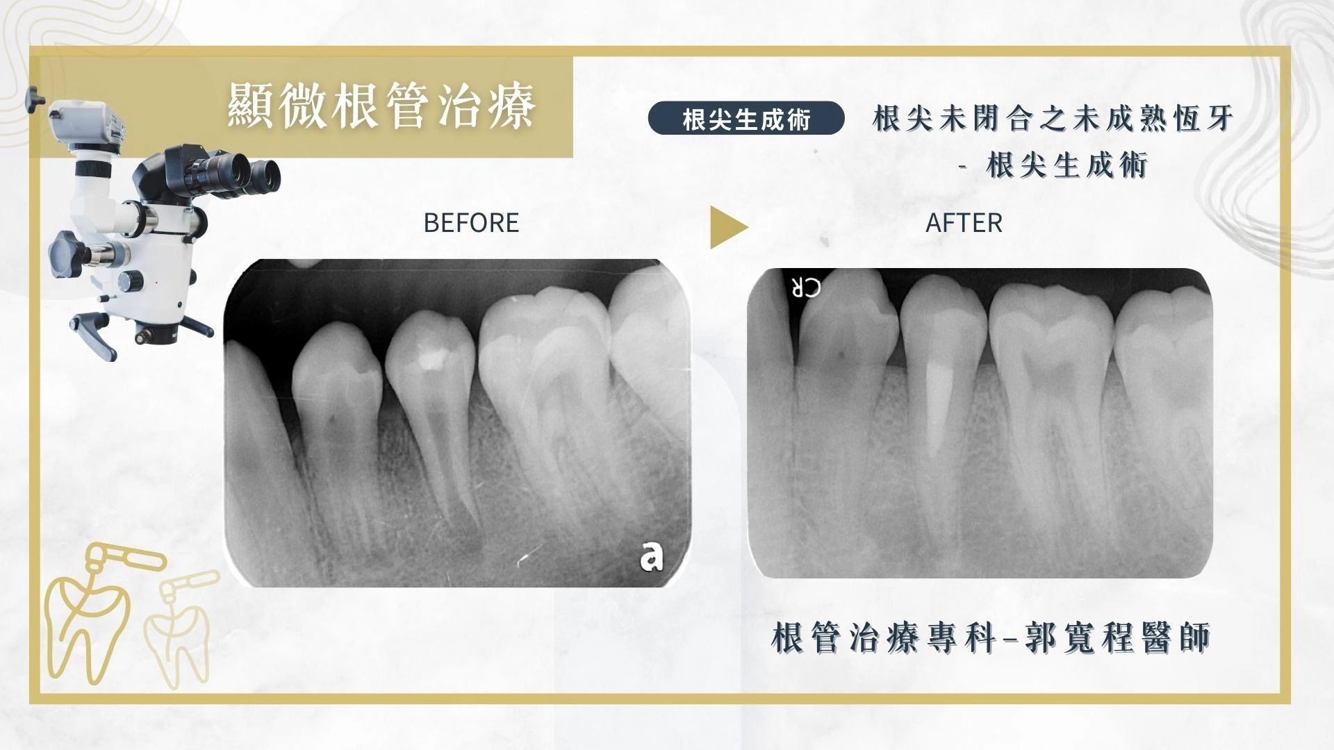 顯微根管治療
