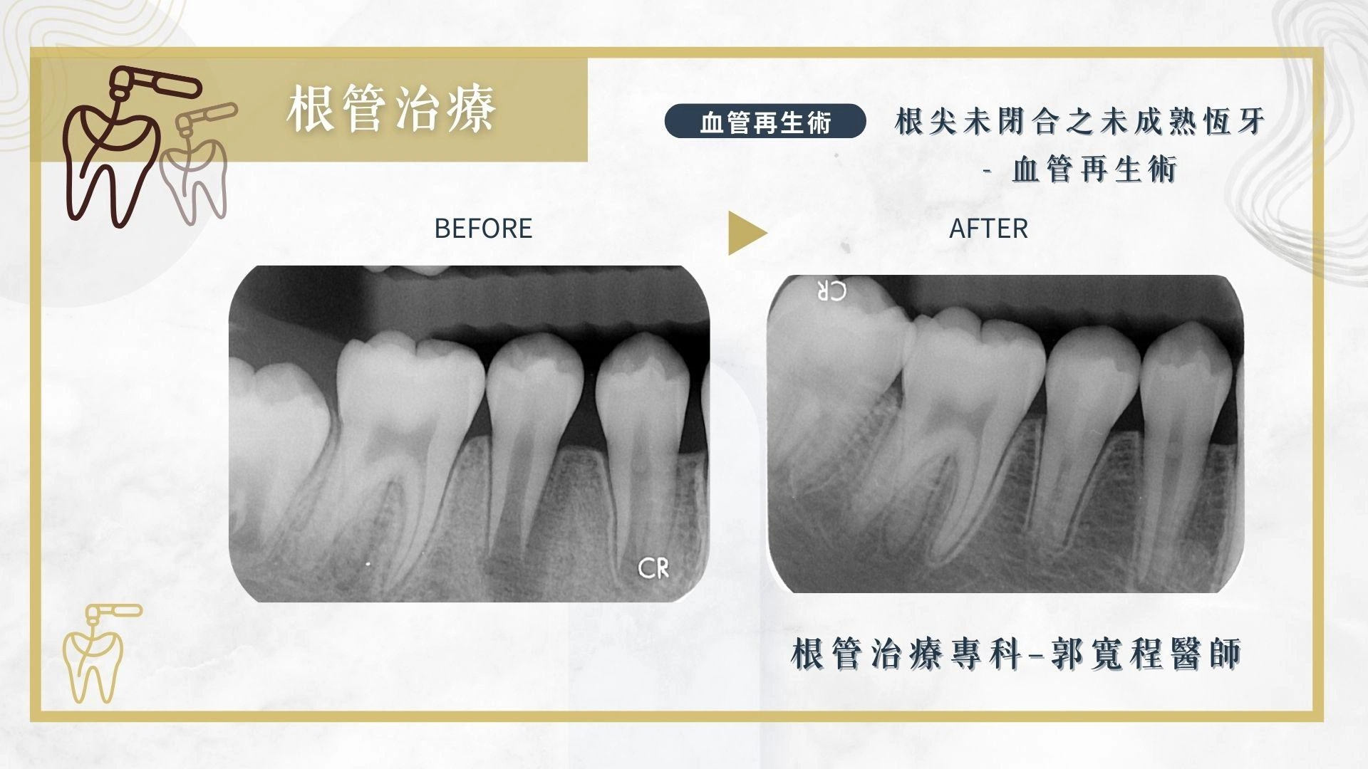 顯微根管治療