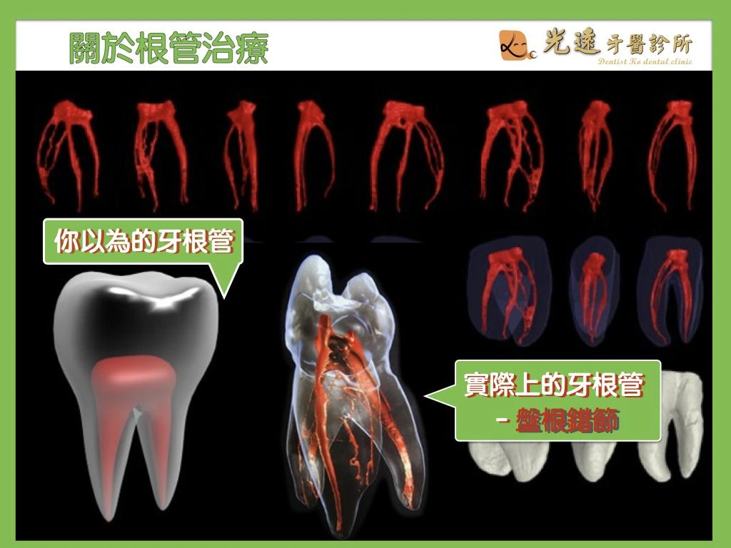 顯微根管治療