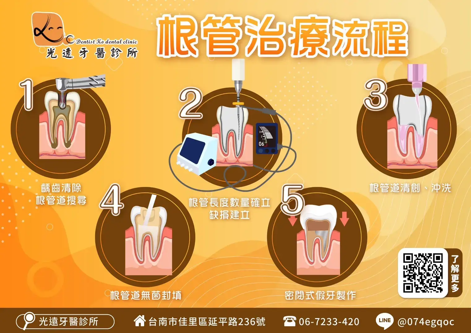 根管治療流程