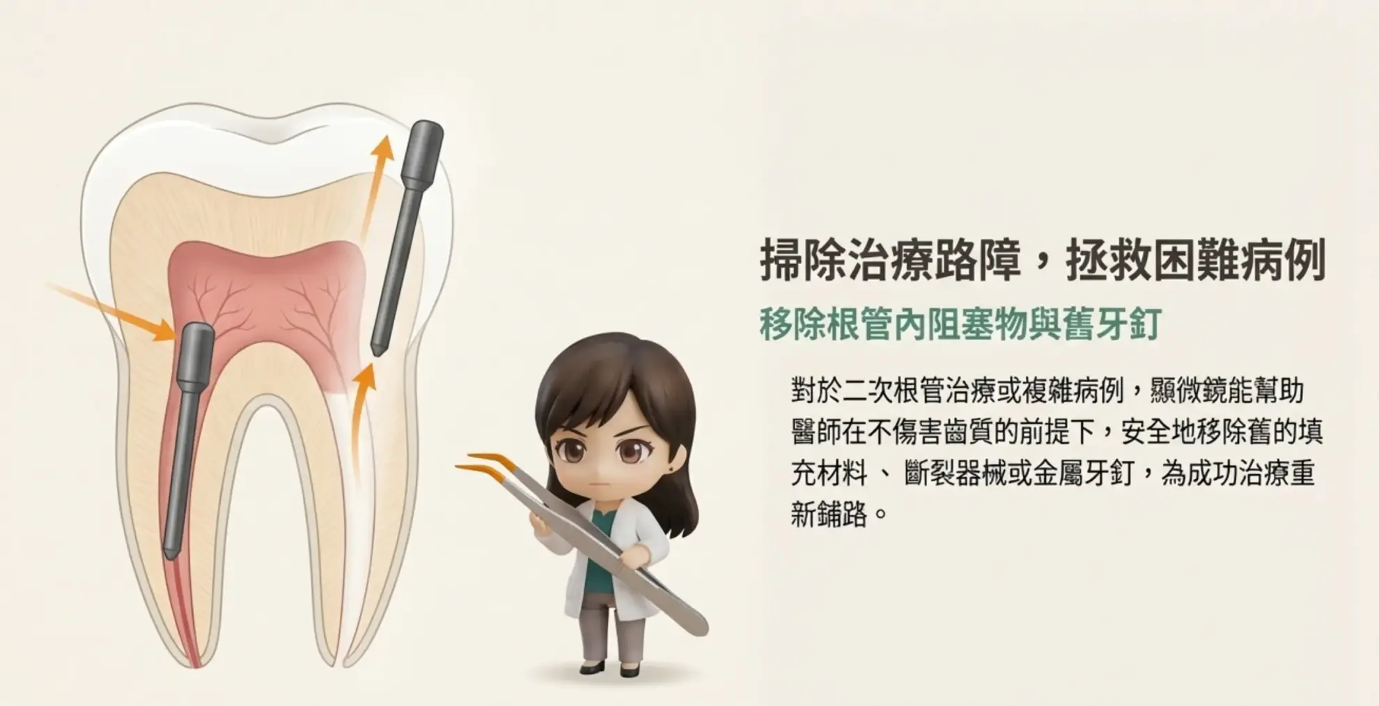 顯微根管治療